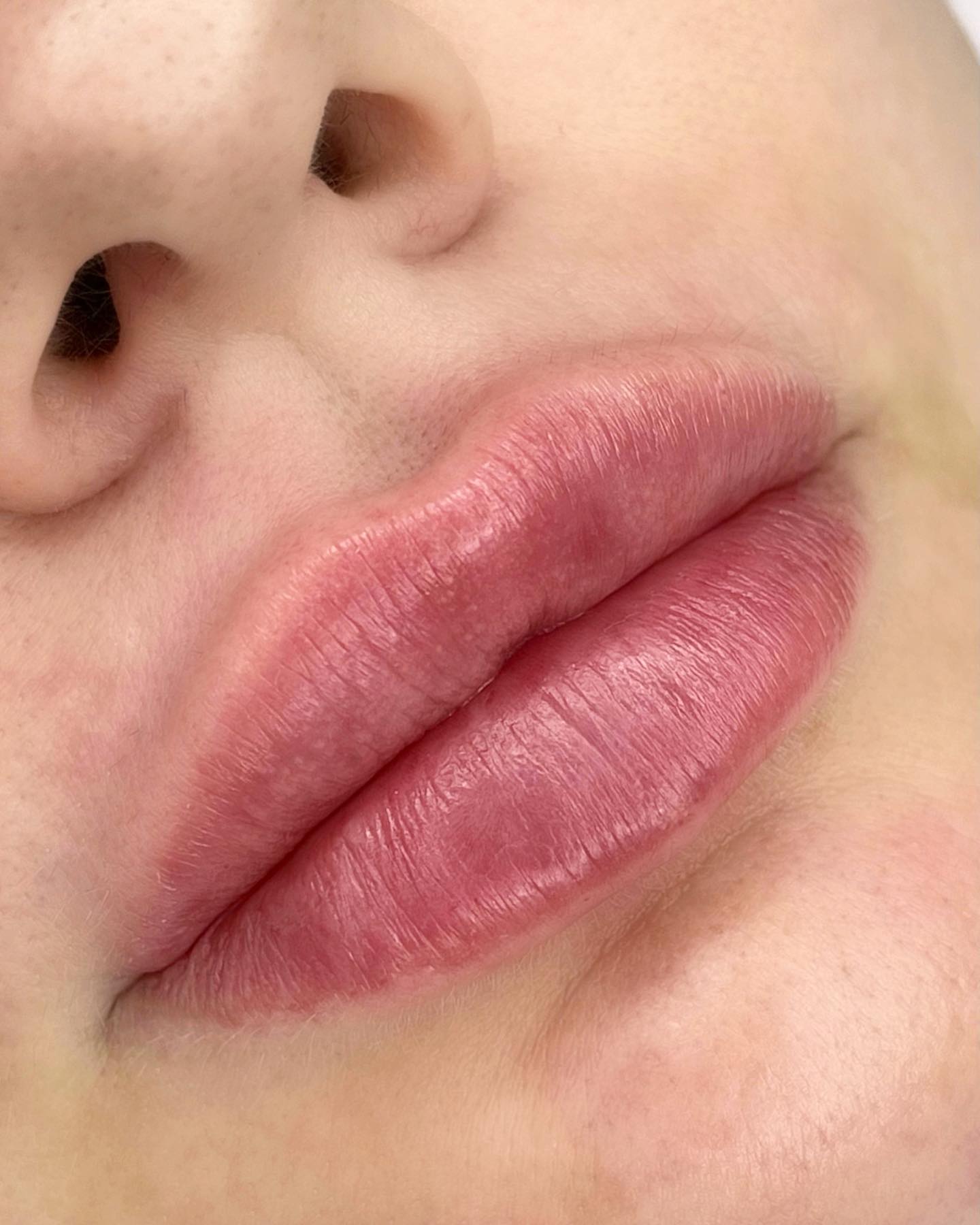 Huulten muotoilu — Albina Räsänen Aesthetics