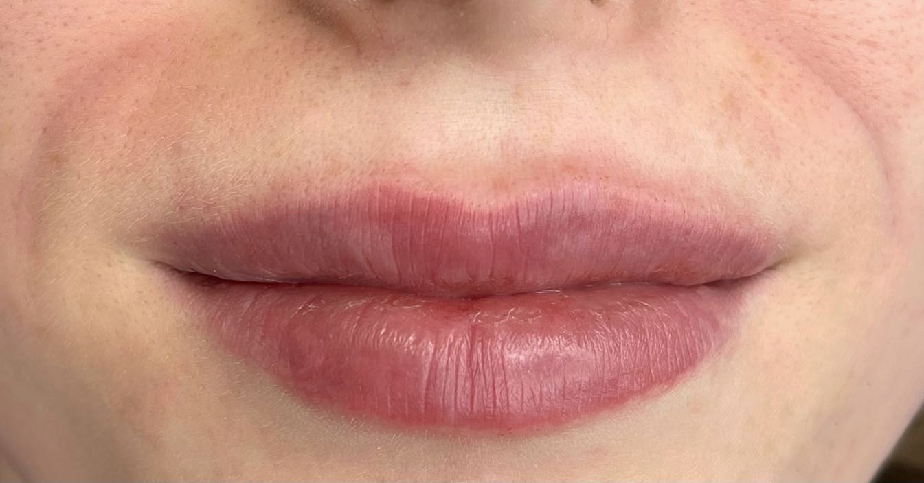 Huulten muotoilu — Albina Räsänen Aesthetics